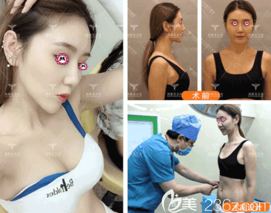 王明利自體脂肪豐胸多錢？JET活性脂肪隆胸價(jià)格低至68000元附案例