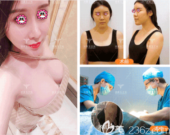 北京潤美玉之光王明利醫(yī)生CGF+JET自體脂肪豐胸案例