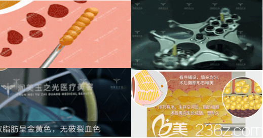 北京潤美玉之光王明利醫(yī)生吸脂提純等相關(guān)信息示意圖