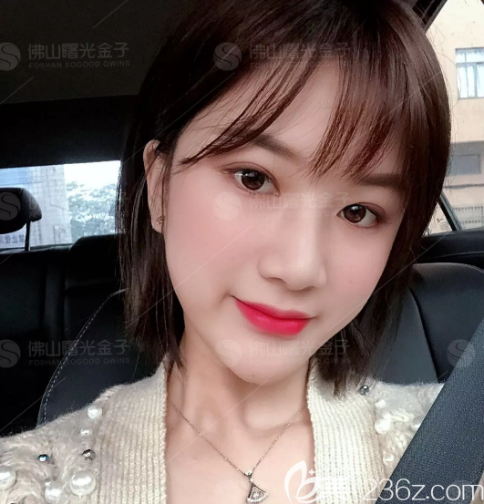 公開我去佛山曙光金子找何宜新院長做童顏線雕埋線提升術后一周的恢復過程圖片