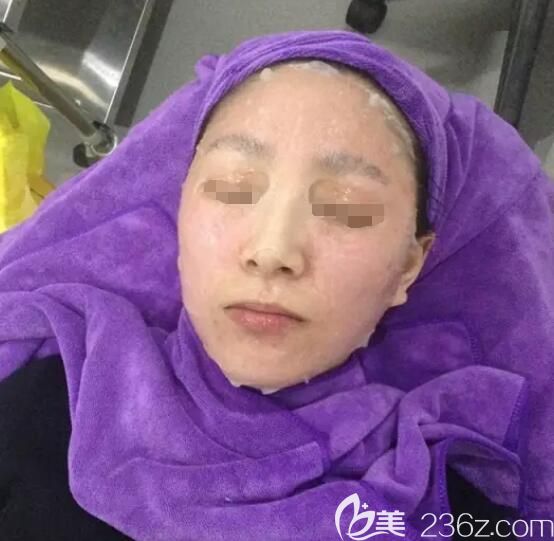 剛做完術(shù)后需要敷醫(yī)用面膜緩解皮膚壓力