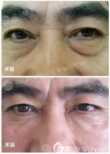 佛山曙光金子甘國(guó)端院長(zhǎng)祛眼袋價(jià)格6800元