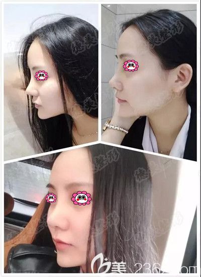 鼻綜合術(shù)后第七天拆線后的照片 鼻綜合術(shù)后第七天拆線后的照片