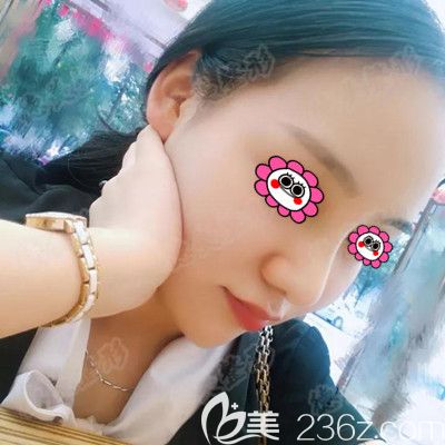 先不說婁底德美整形怎么樣，直接上傳某網(wǎng)紅找符恒做鼻綜合1個(gè)月的恢復(fù)照