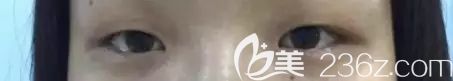 面診王武坤醫(yī)生術前茹茹單眼皮 面診王武坤醫(yī)生術前茹茹單眼皮