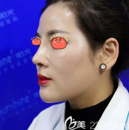 本人在義烏陽光醫(yī)院做的全肋骨鼻:肋骨鼻梁+肋骨鼻尖,同時還墊下巴把突嘴問題改善了