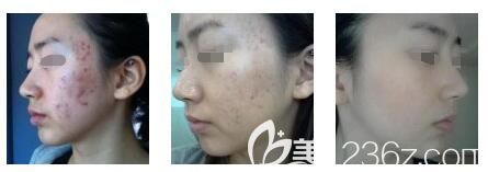 張培紅醫(yī)生激光祛痘案例 張培紅醫(yī)生激光祛痘案例