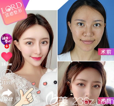 青島自體脂肪填充面部案例一