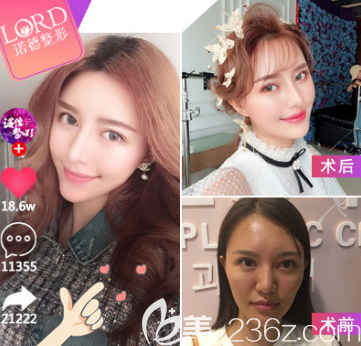 青島自體脂肪填充改善凸嘴案例二