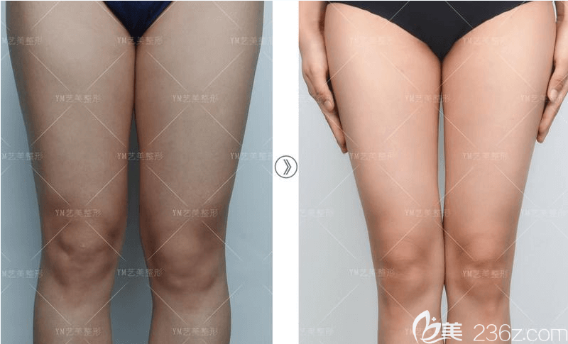 北京藝美王東腿部吸脂案例 北京藝美王東腿部吸脂案例