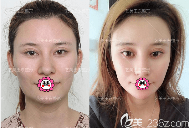 北京藝美王東不開刀去下頜角案例 北京藝美王東不開刀去下頜角案例