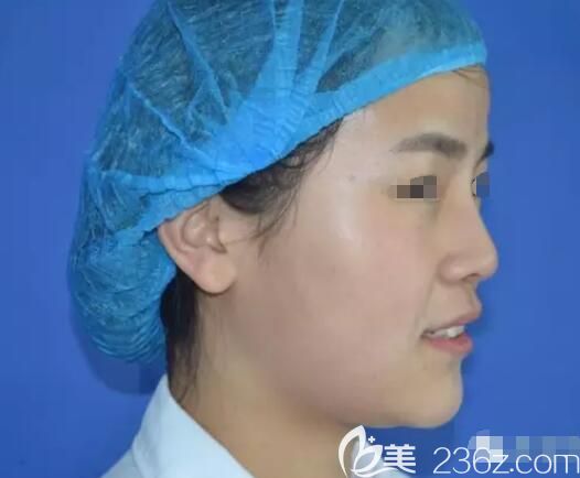 剛做完艾莉薇玻尿酸注射隆鼻效果 剛做完艾莉薇玻尿酸注射隆鼻效果