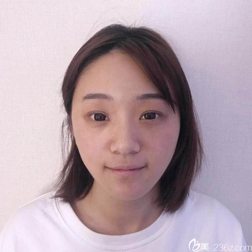 埋線雙眼皮失敗后照片 埋線雙眼皮失敗后照片