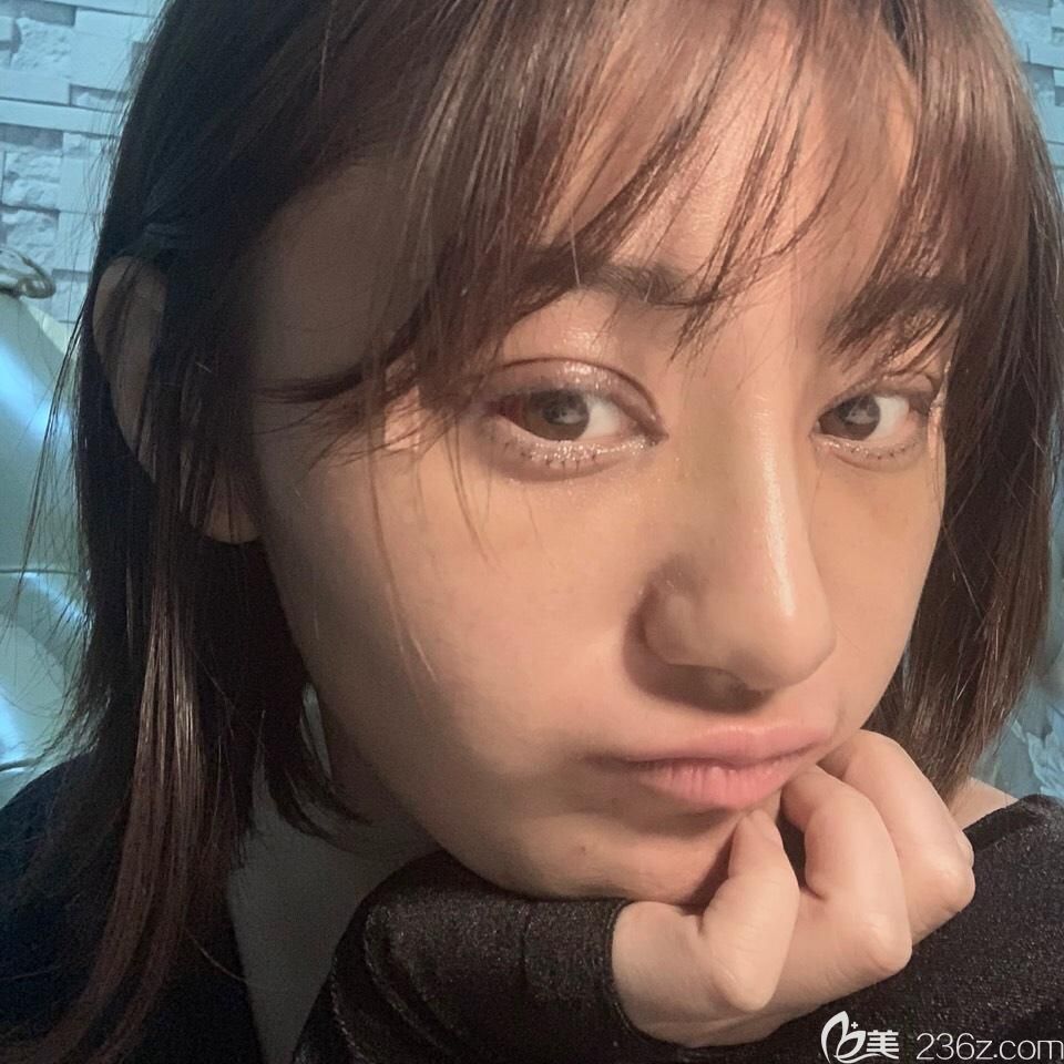 找胡準(zhǔn)做雙眼皮失敗修復(fù)+鼻綜合第4天 找胡準(zhǔn)做雙眼皮失敗修復(fù)+鼻綜合第4天