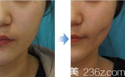 韓國Noble&Cosmo整形外科酒窩形成術(shù)案例 韓國Noble&Cosmo整形外科酒窩形成術(shù)案例