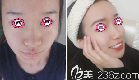 北京藝美范憲紅醫(yī)生全臉自體脂肪填充案例 北京藝美范憲紅醫(yī)生全臉自體脂肪填充案例