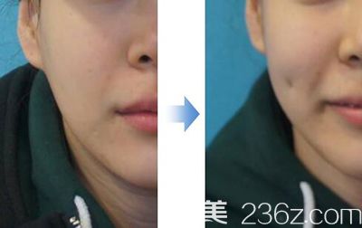 酒窩形成術(shù)案例展示 酒窩形成術(shù)案例展示