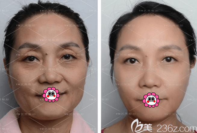 北京藝美王東醫(yī)生脂肪抗衰案例 北京藝美王東醫(yī)生脂肪抗衰案例