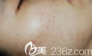 在韓國海德仁醫(yī)院算是祛痘順利，真的太不容易了