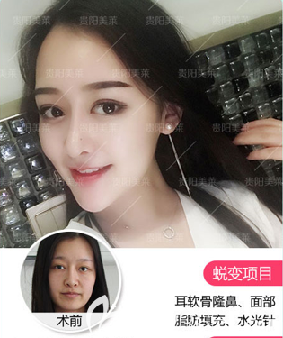 貴陽(yáng)美萊自體脂肪面部填充怎么樣