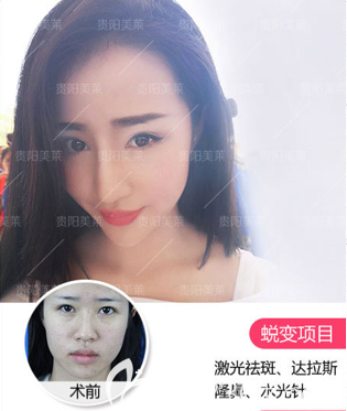 貴陽(yáng)美萊隆鼻好不好？