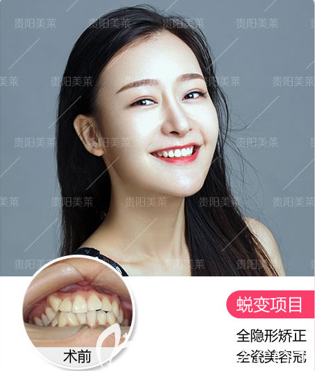 貴陽(yáng)美萊哪個(gè)醫(yī)生做牙齒矯正好