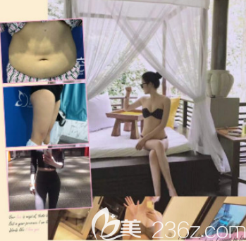 青島吸脂全身案例