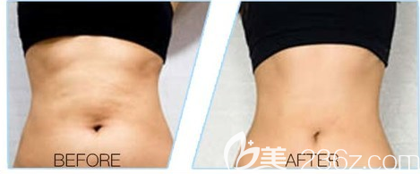 青島華顏美吸脂腰腹部案例