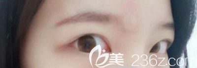 在韓國本愛做眼綜合手術前 在韓國本愛做眼綜合手術前