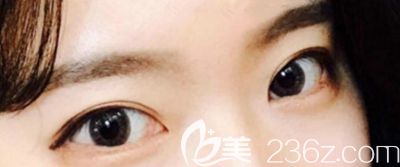 妹子天生內(nèi)雙 找韓國本愛醫(yī)院的文圣昊院長做了眼綜合手術(shù)后就改善了這個(gè)問題