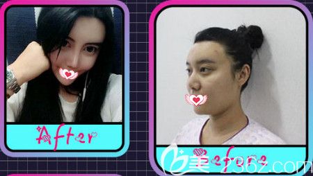 邯鄲華美4月整形又降價(jià) 硅膠隆鼻和微針美塑優(yōu)惠活動(dòng)價(jià)為3080元