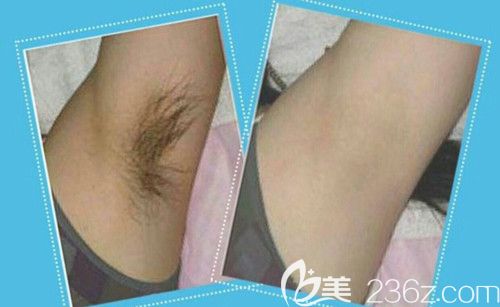 華美整形醫(yī)院激光脫毛案例