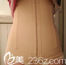 我在南寧韓星整形做腰腹部360度吸脂15天效果 我在南寧韓星整形做腰腹部360度吸脂15天效果