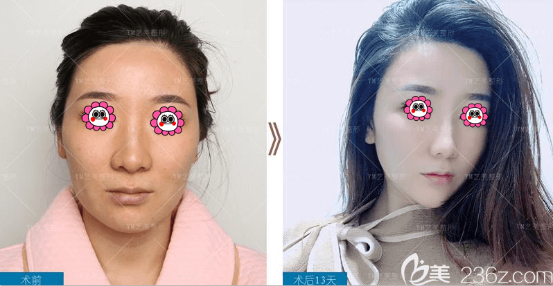 北京藝美整形價(jià)格表 不開刀去下頜角低至68800元，脂肪填充失敗修復(fù)低至26000元