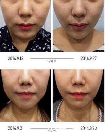 韓國美爾韓面部埋線提升案例