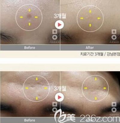 韓國美爾韓美膚治療案例