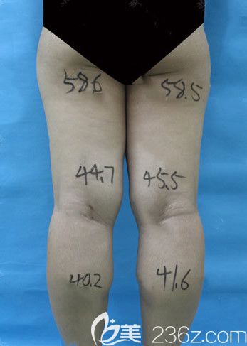 呼和浩特京美整形醫(yī)院腿部吸脂前 呼和浩特京美整形醫(yī)院腿部吸脂前
