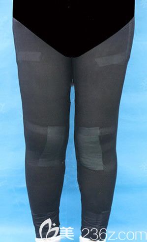 大腿吸脂和小腿吸脂第1天 大腿吸脂和小腿吸脂第1天