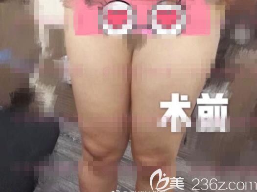 韓國(guó)元辰醫(yī)院吸脂案例 韓國(guó)元辰醫(yī)院吸脂案例