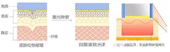 激光美膚的原理