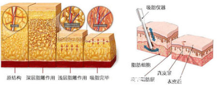 吸脂示意圖