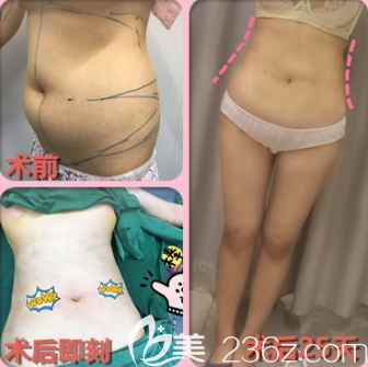 寶麗太吸脂的案例