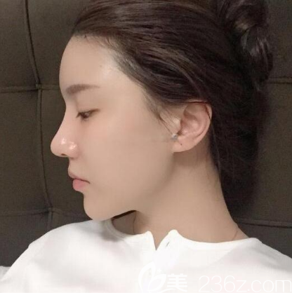 找深圳富華斯良洪做鼻修復術后7天的樣子 找深圳富華斯良洪做鼻修復術后7天的樣子