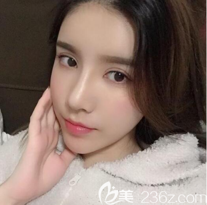 在深圳富華做鼻修復術后25天消腫效果 在深圳富華做鼻修復術后25天消腫效果