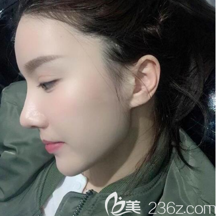 確定深圳富華是正規(guī)整形醫(yī)院后我找斯良洪醫(yī)生做了隆鼻失敗修復(fù)手術(shù)