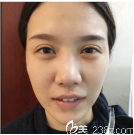 在深圳富華做隆鼻修復前的照片 在深圳富華做隆鼻修復前的照片