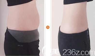 腰腹吸脂手術案例 腰腹吸脂手術案例