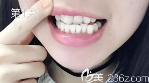 找洛陽拜博口腔畢芳矯正前第1天戴隱形牙套