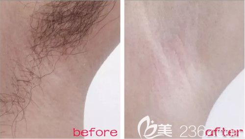 邯鄲雅麗4月整形優(yōu)惠季脫毛包年38元 假體隆鼻和單部位吸脂880元