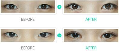 眼綜合手術(shù)案例 眼綜合手術(shù)案例